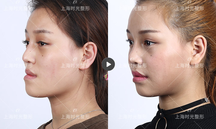 地包天如何矫正_地包天矫正多少钱_上海地包