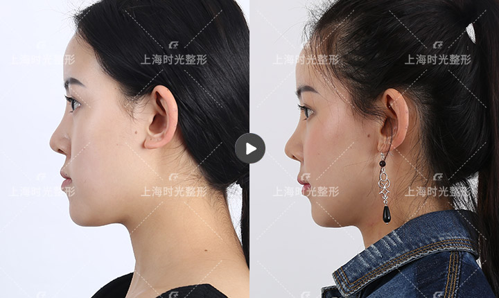 地包天如何矫正_地包天矫正多少钱_上海地包